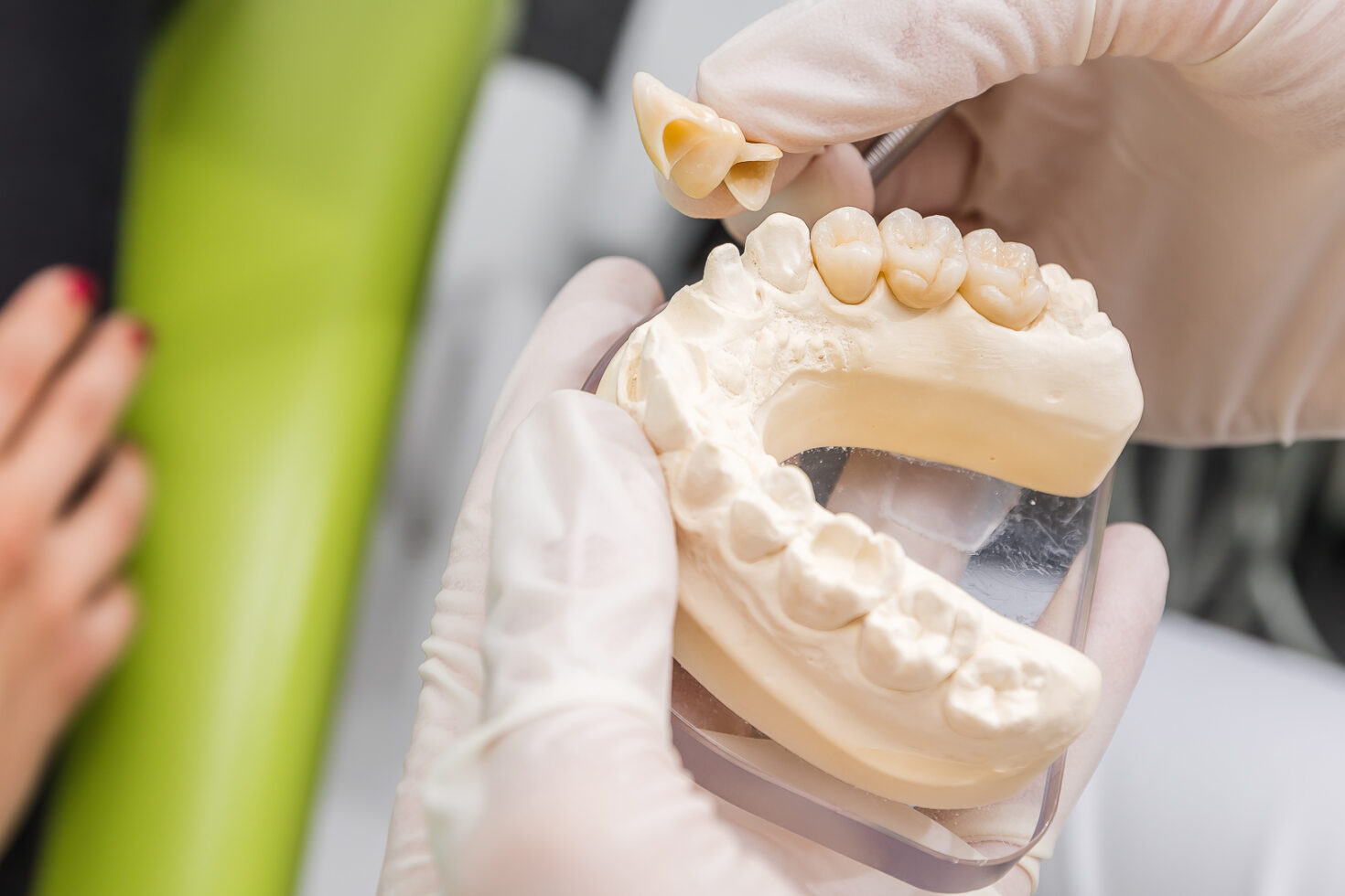 Dental bridge