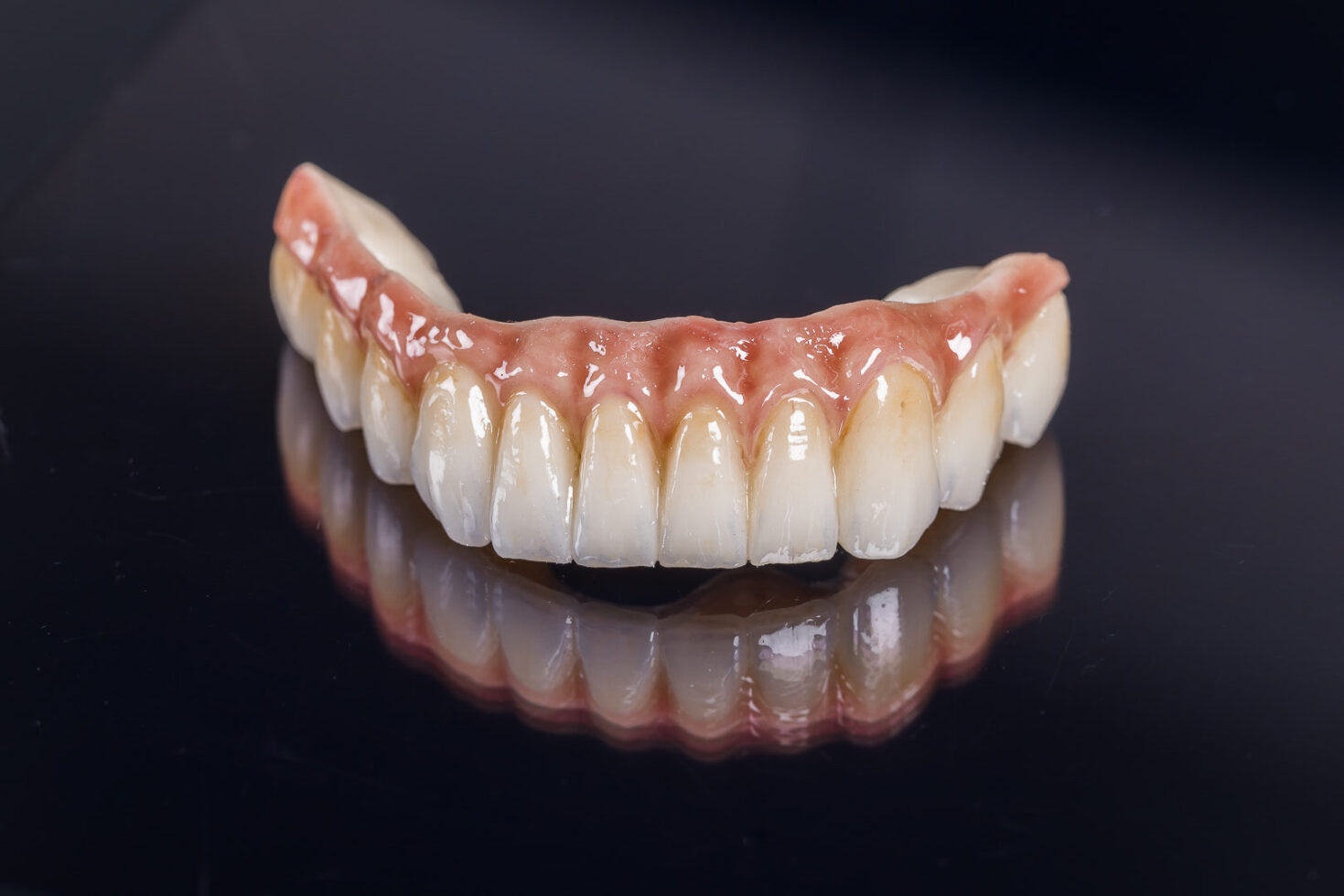 4. Les prothèses sur implants